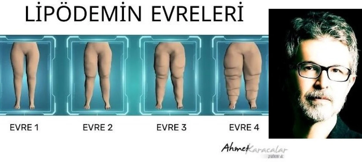Kilo veremiyorsanız suçlu iradeniz değil, lipödem olabilir
